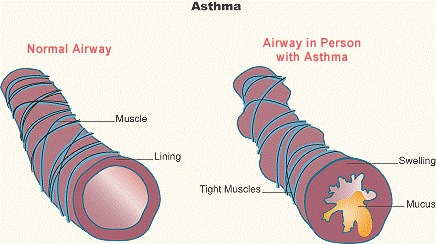 Asthmatic constriction